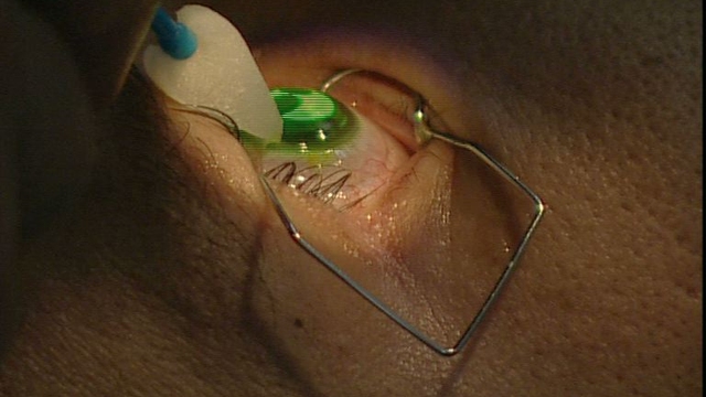 Barraquer Eyes Barraquer Eyes